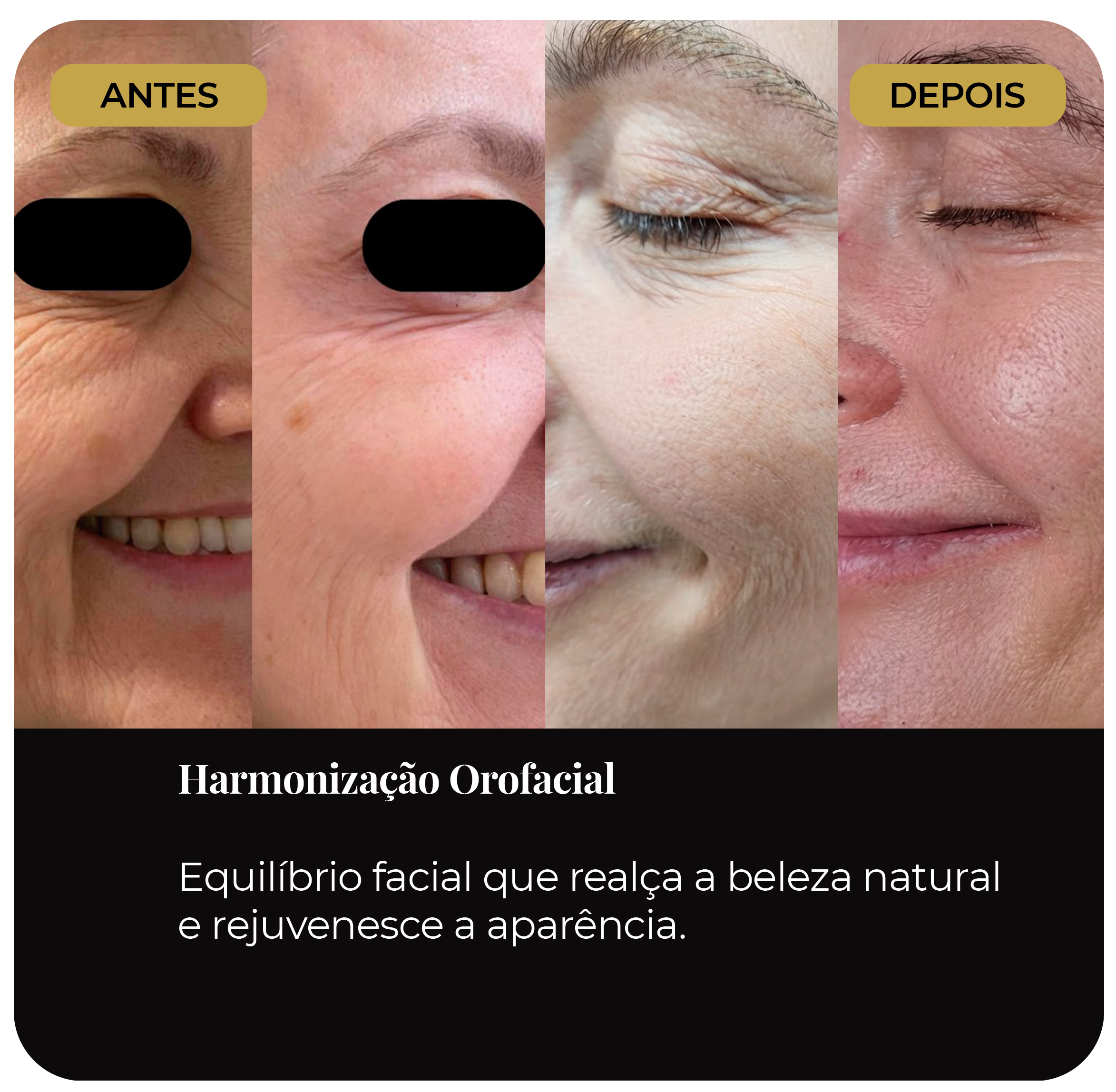 Sequência comparativa de antes e depois de procedimento de harmonização orofacial para rejuvenescimento e equilíbrio facial.