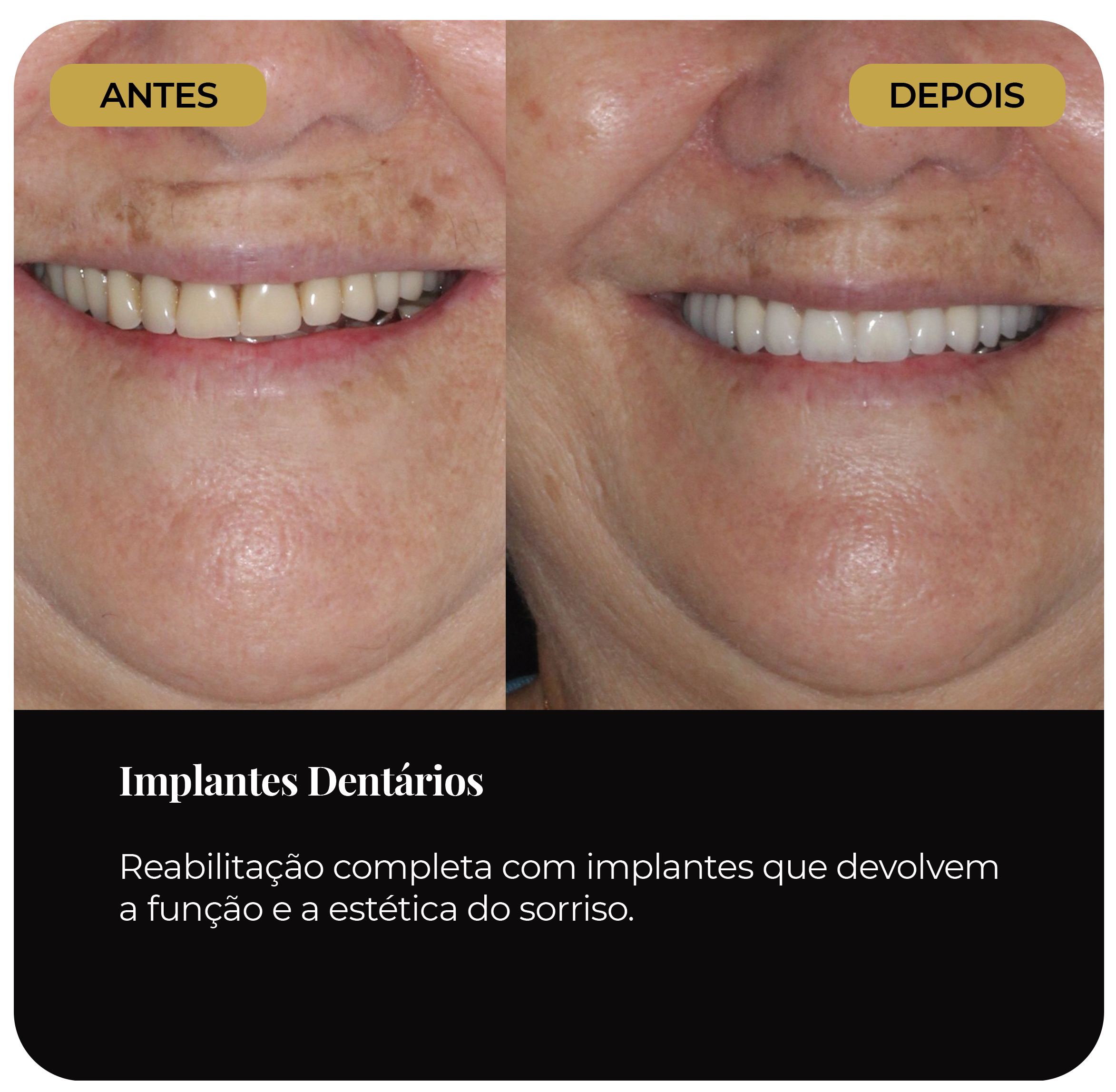 Antes e depois de reabilitação oral com implantes dentários mostrando a evolução da estética do sorriso.